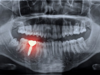 歯を失う原因は大きく2つあります